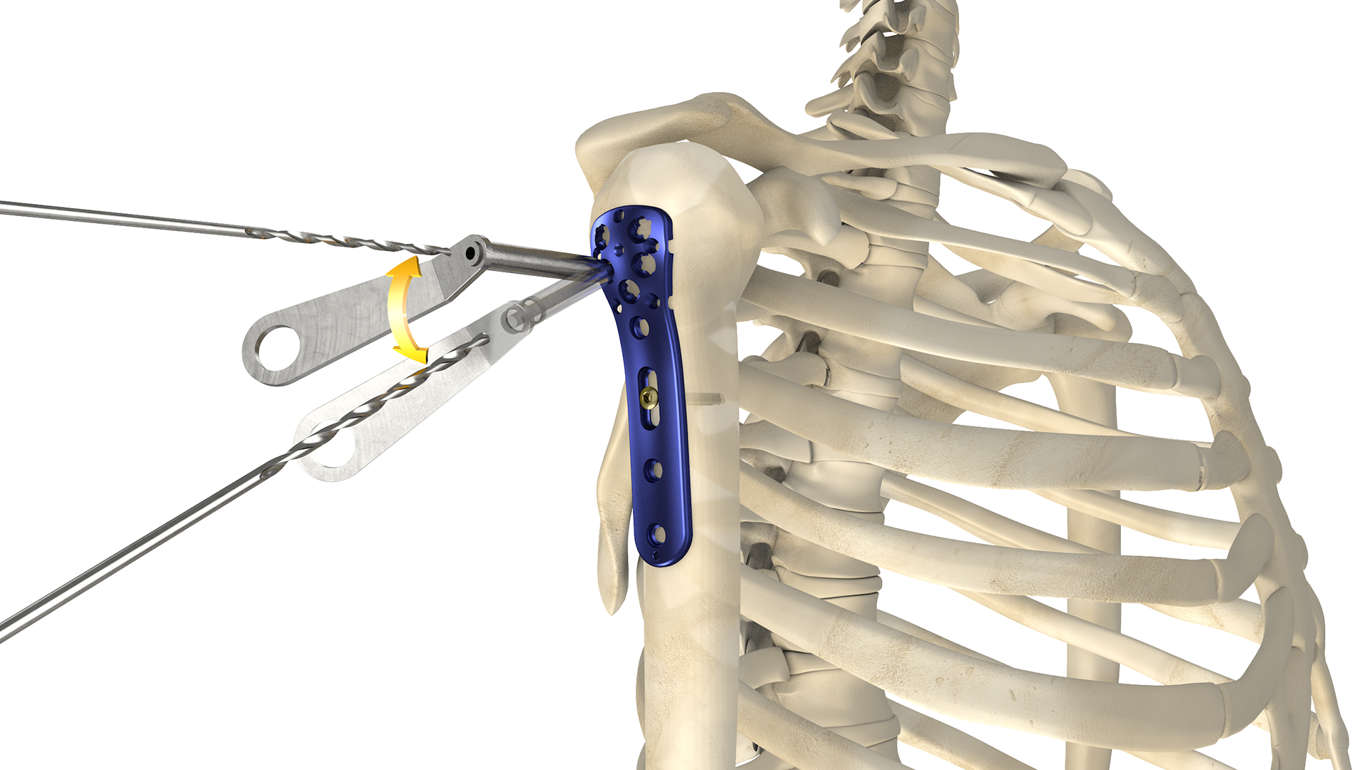 proximaler humerus five