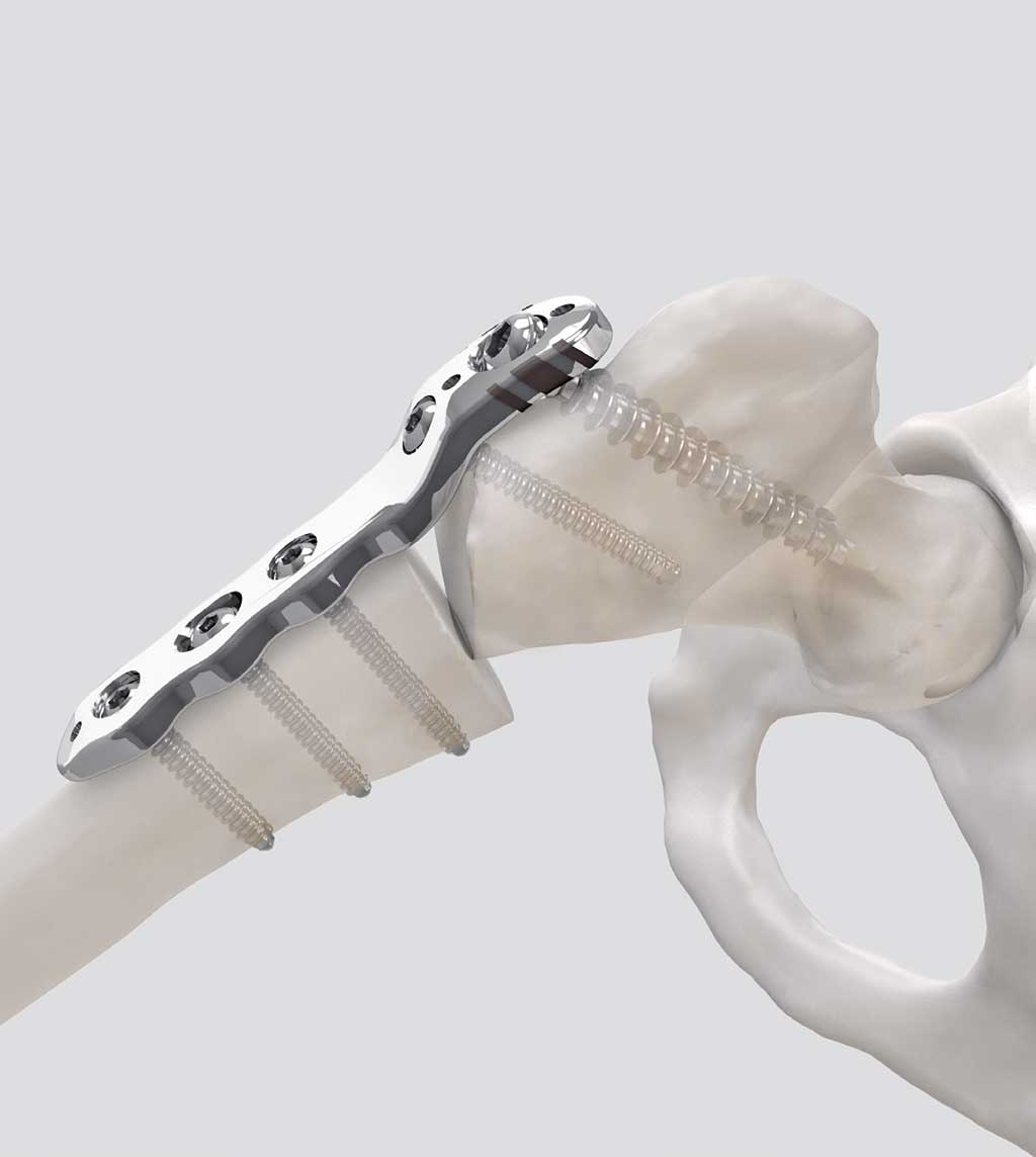 Königsee Implantate Produkt: WiKo® Proximale Femur-Umstellungsplatte Anwendungsbeispiel aus der Kategoerie Kinder