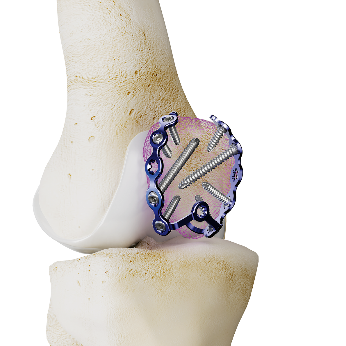 Patella Platte Koenigsee Implantate